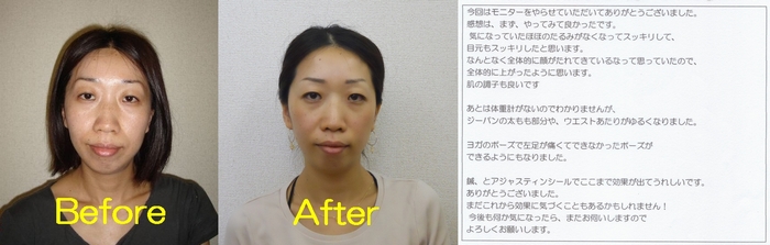 フェイスラインがスッキリとし、顔のバランスも良くなりなした